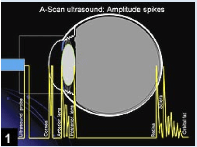 A-Scan-Ultraschallbiometrie